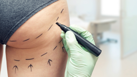 A Stunning Shift in Aesthetic Regulations: Botox and Brazilian Butt Lift Law Passed!