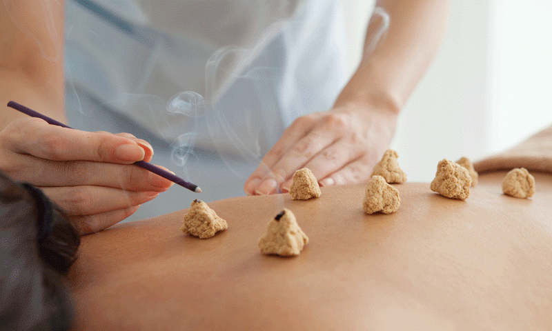 acupuncturist's hands lighting Mona cones on a patient's back