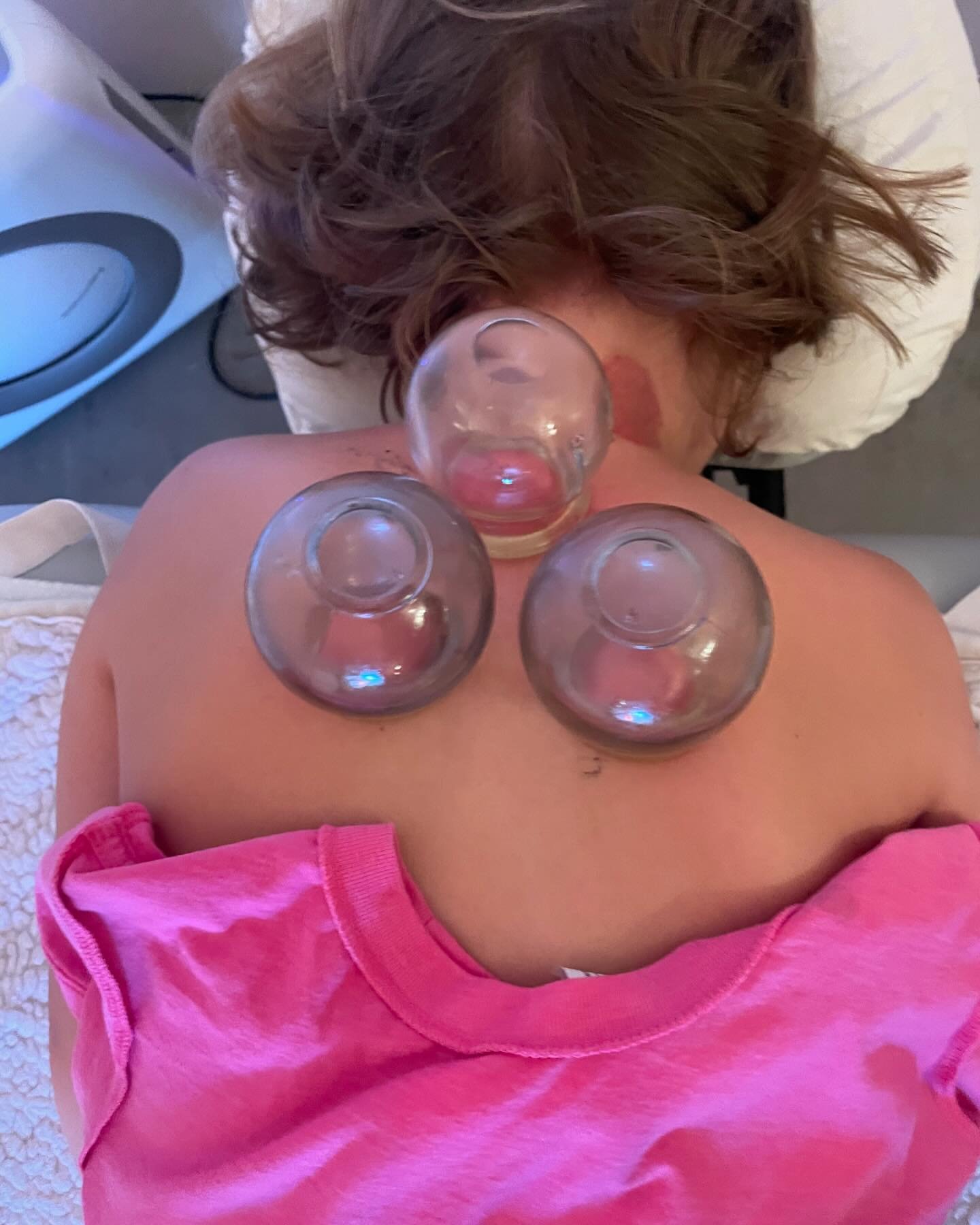 Nothing is sweeter than a day spent at home with a sick kid.  Here&rsquo;s a flash back to the last time she was sick and requested fire cupping.  She asked for the ones on her neck, and sighed with relief.  Cupping helps to release all the muscles a