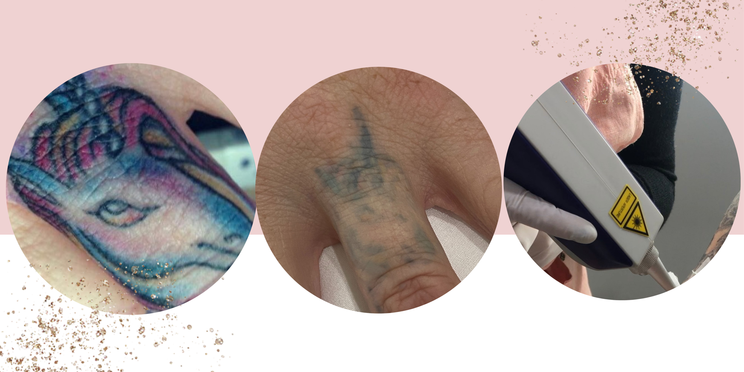 Get Your Free Tattoo Removal Consultation