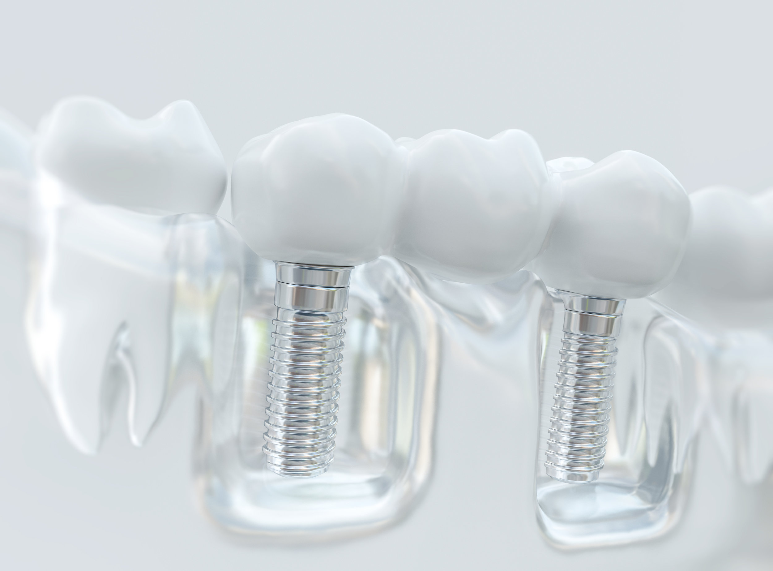 If you have dentures you can now kiss them goodbye and replace them with permanent teeth. 