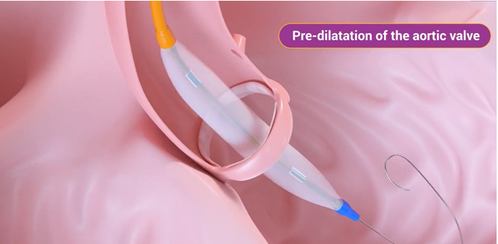 Tavi Procedure What Is Transcatheter Aortic Valve Implantation Tavi Myval