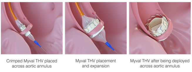 Figure 1. Myval THV TAVR procedure