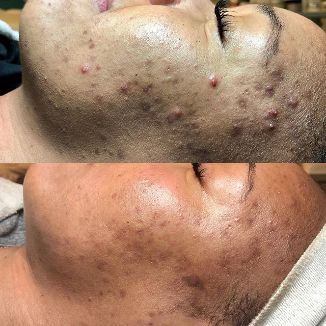 I had 1 month to work my magic. My client lives out of state and was getting married. She came back to the Bay Area and while she was here I was able to do a Dermal Infusion on her 3 times. So in 1 month I did a Dermal Infusion, Mandelic acid and A LOT of extractions. I also changed her home care routine adding a Salicylic cleanser, Brightening pads, Glycolic acid, Pigment gel, Apres hydrating balm and Spf. With only 1 month to work my magic I feel pretty good with the transformation of her skin! #felizduboisskincare #hardworkpaysoff #diligence #homecareroutine #dermalinfusion #chemicalpeels #extractions #gettingmarried #acnetreatments #envymedical #montclairvillage #oakland