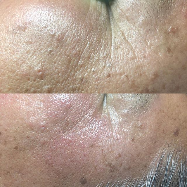 Soalr comedones affect areas that have been exposed to sunlight over a long period of time. This is my client who loves the sun! With a dermal Infusion treatment and extractions he is all cleaned up! #felizduboisskincare #dermalinfusion #extractions #solarcomedones #facialtreatment #manfacials #metro #montclairvillage #oakland