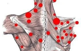 Trigger+points+image.jpg