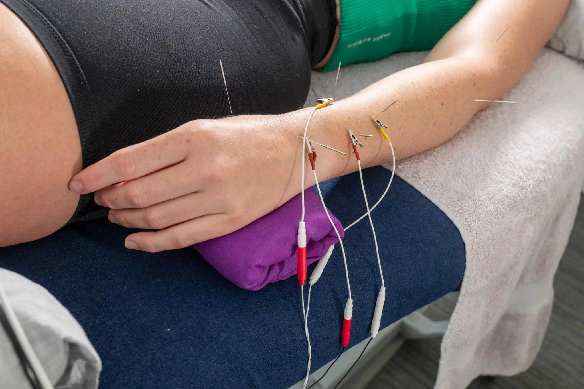 Electro acupuncture treatment applied to a patient's forearm during an acupuncture Gold Coast session for pain and inflammation.