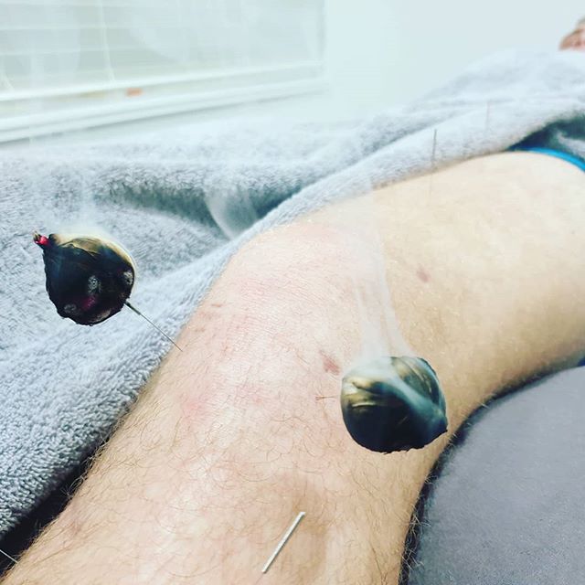 Not many people think of acupuncture for post-operative pain. We have found acupuncture to be an exceptional adjunct therapy to rehabilitation of ACL reconstructions and knee replacements. Get further faster.

Visit our website www.traditional-acupun