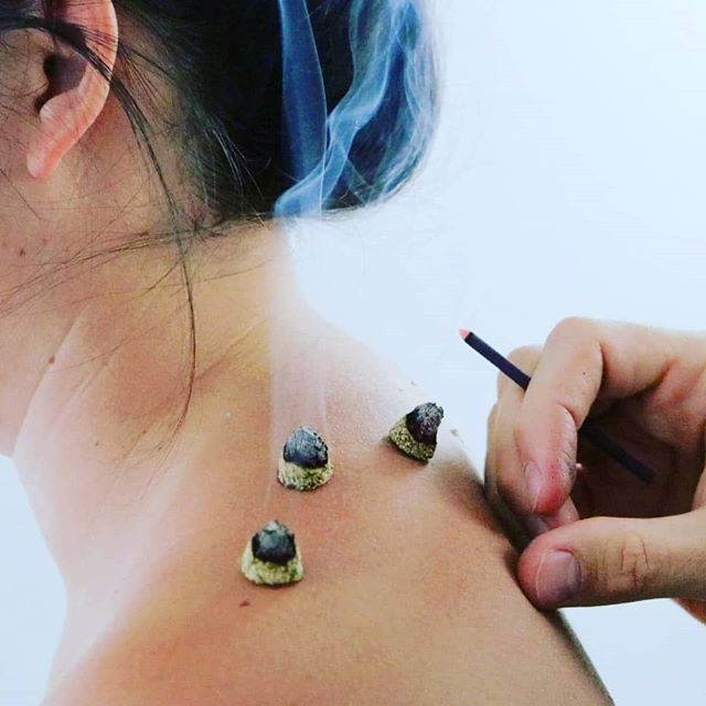 Moxibustion is a common adjunct to acupuncture treatment. In this photo we are strategically applying heat to hard painful tissue on the shoulders and upper back. Makes a nice photo too.