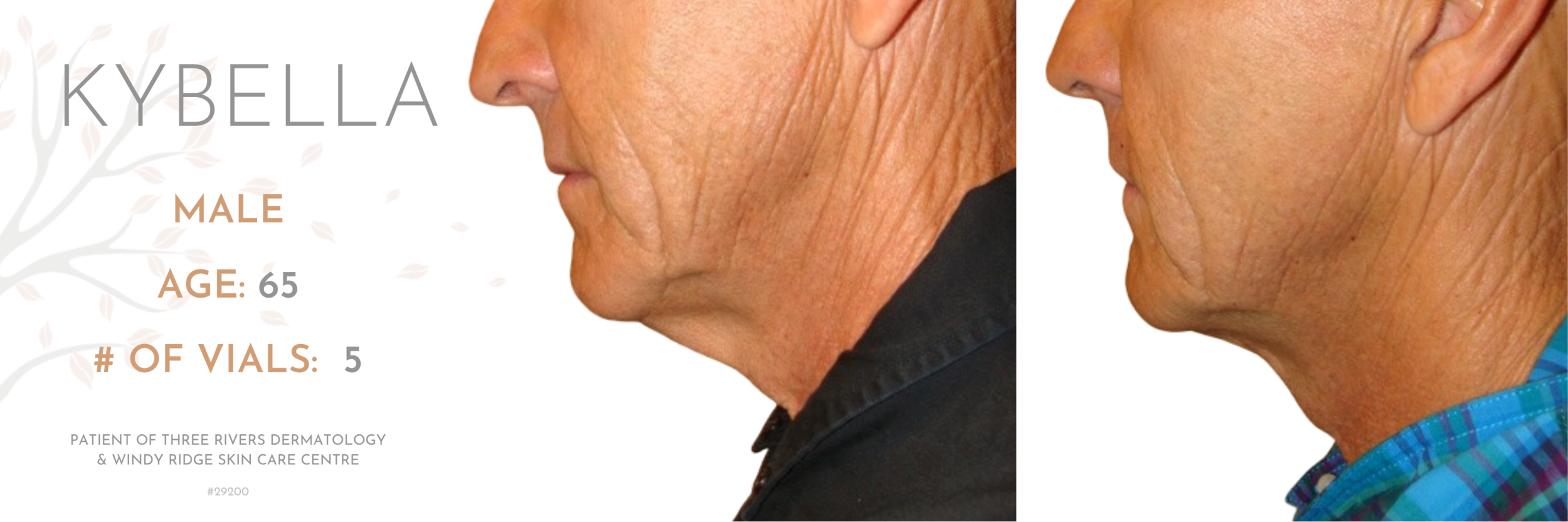 Kybella-#29200.png