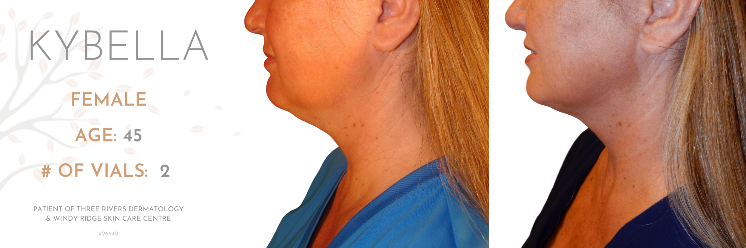 Kybella-#26640.png