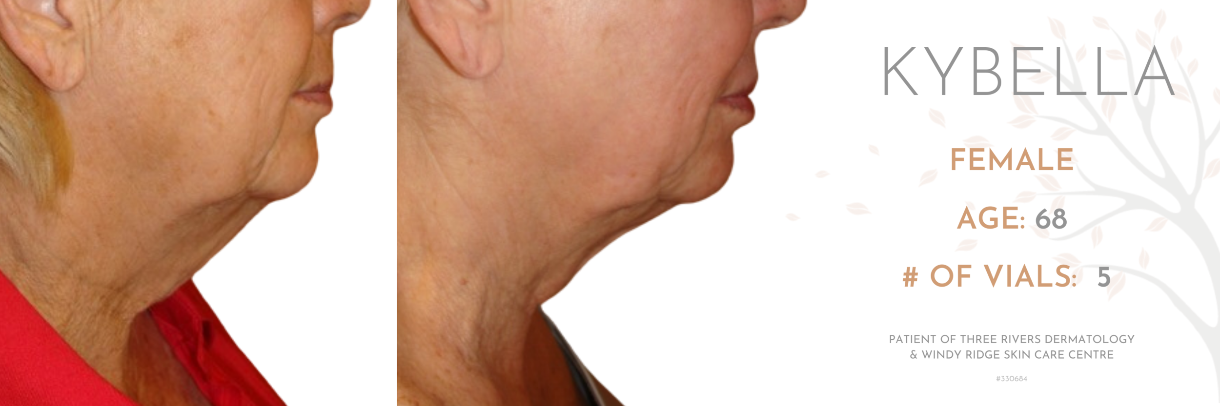 Kybella-#330684.png