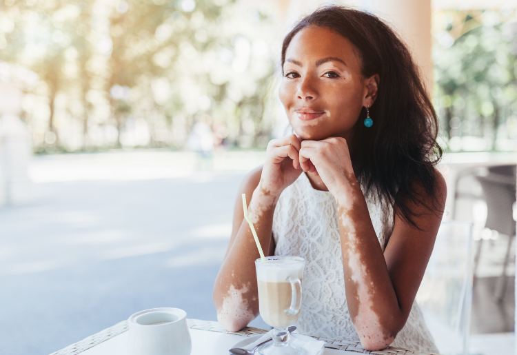 Vitiligo