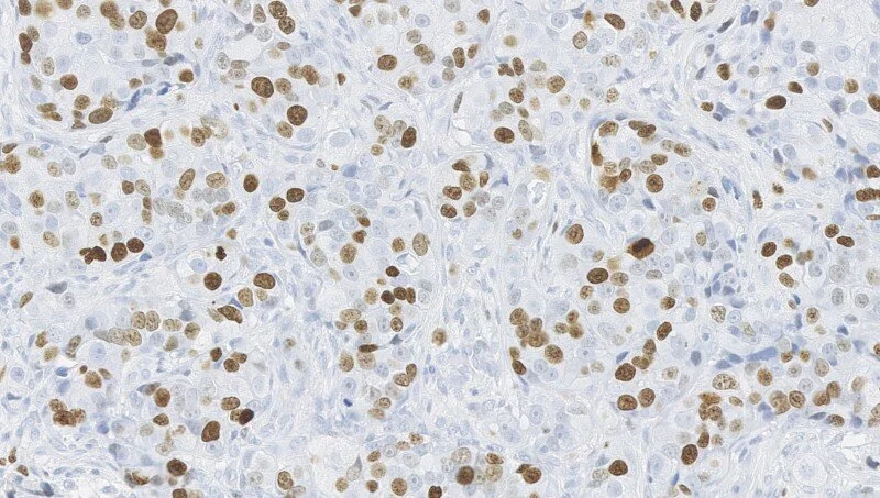 An algorithm to triage breast cancer surgery