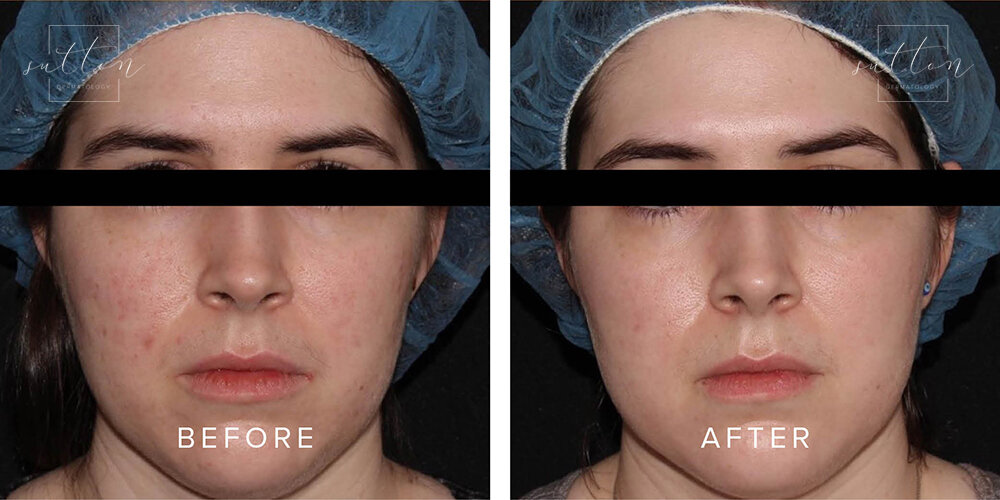 sutton-cosmetic-before-after-acne-treatment-vancouver.jpg
