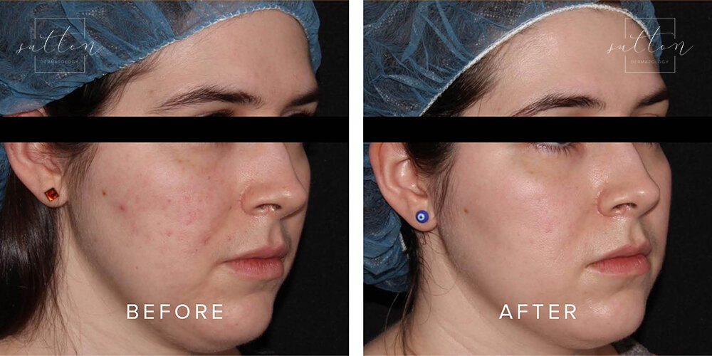 sutton-cosmetic-before-after-acne-treatment-vancouver1.jpg