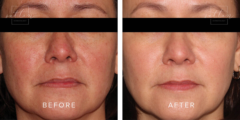 sutton-cosmetic-before-after-roseaca-treatment-vancouver1.jpg