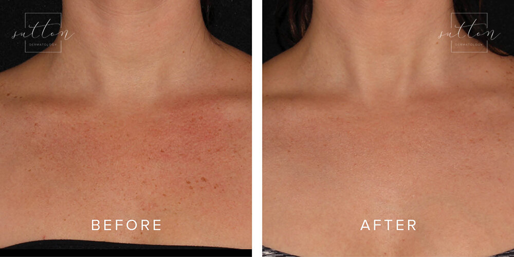 sutton-cosmetic-before-after-roseaca-treatment-vancouver2.jpg