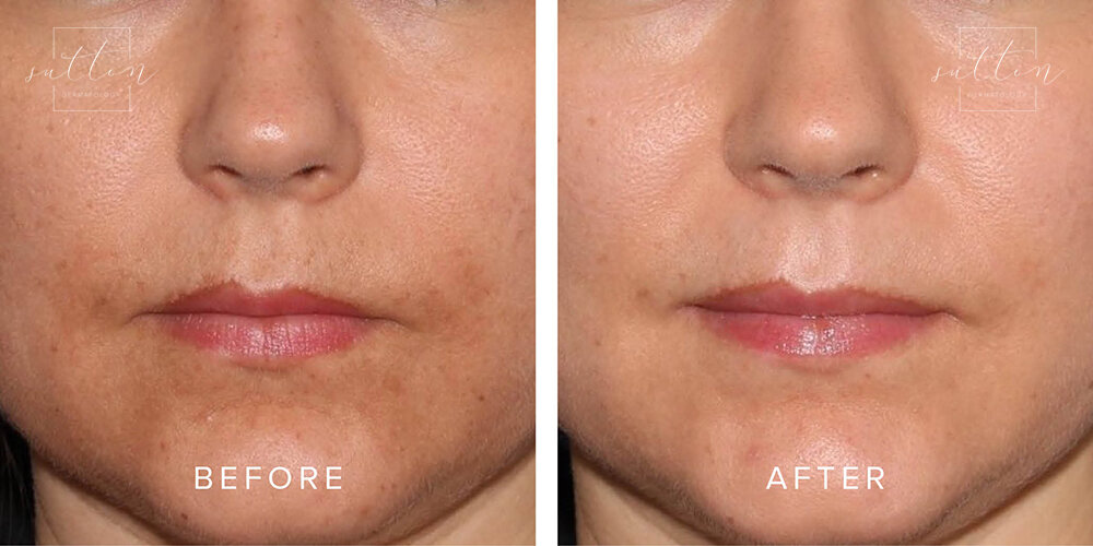 sutton-cosmetic-before-after-melasma-treatment-vancouver2.jpg