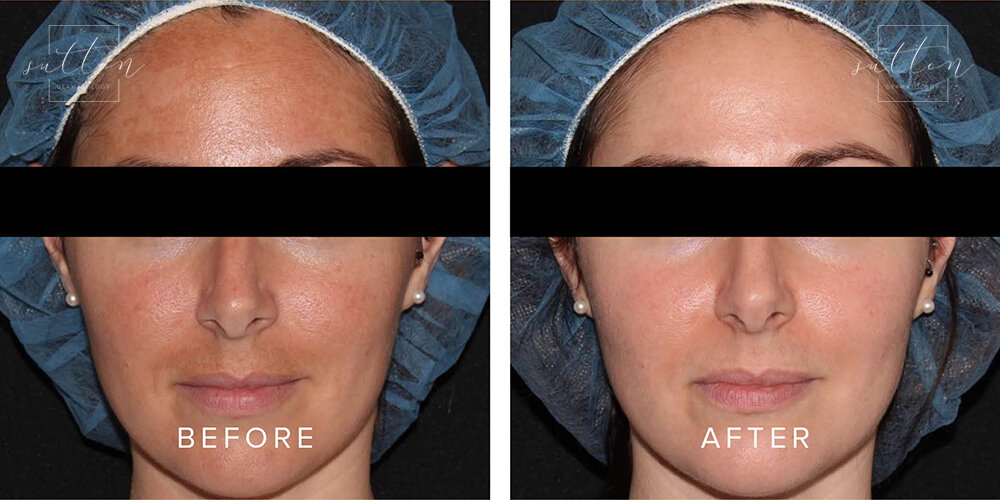sutton-cosmetic-before-after-melasma-treatment-vancouver.jpg