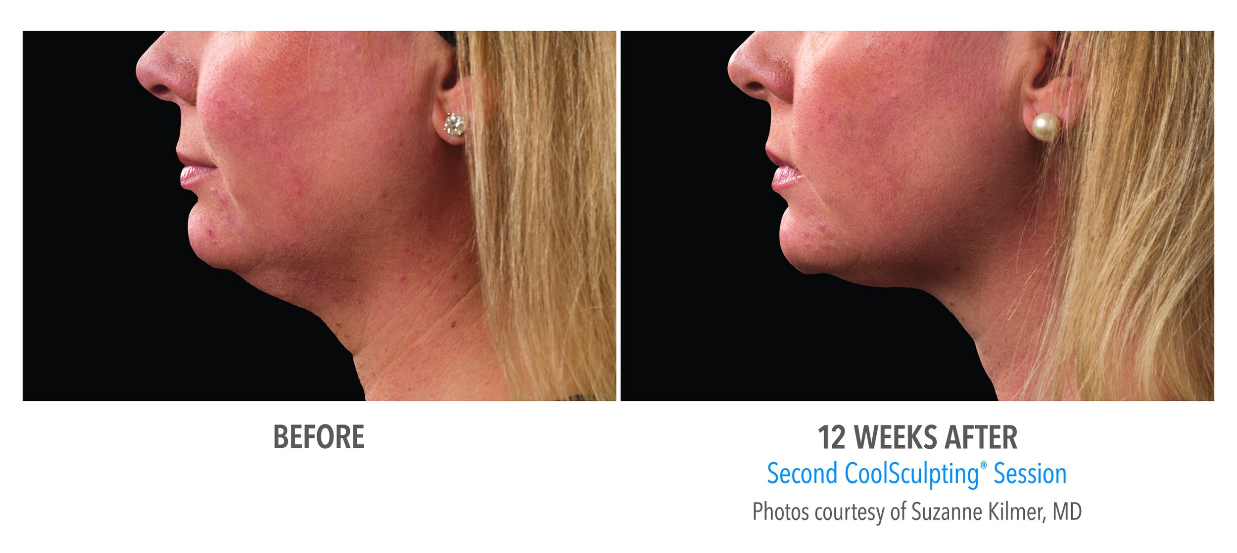 West Dermatology Vancouver CoolSculpting  Chin 1.jpg