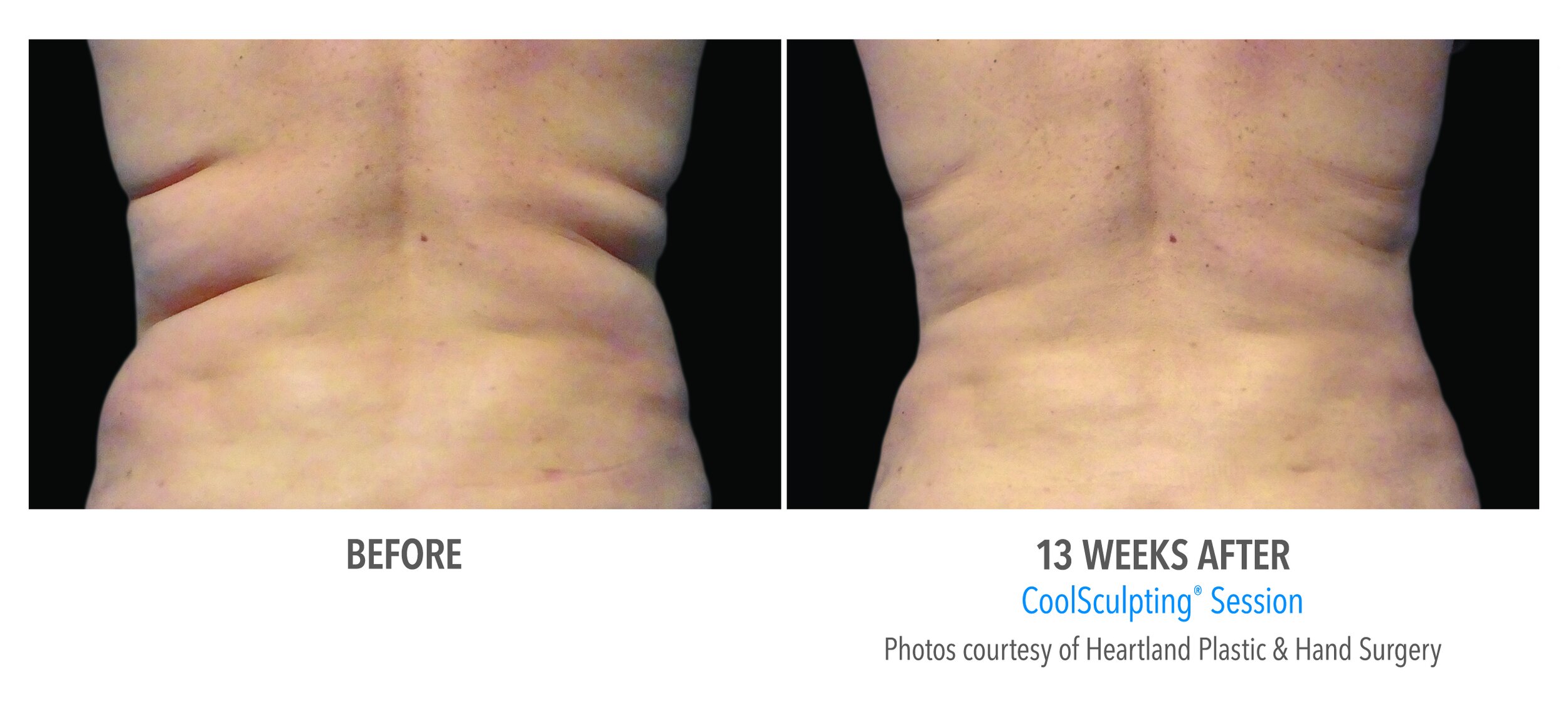 West Dermatology Vancouver CoolSculpting  Flanks 1.jpg