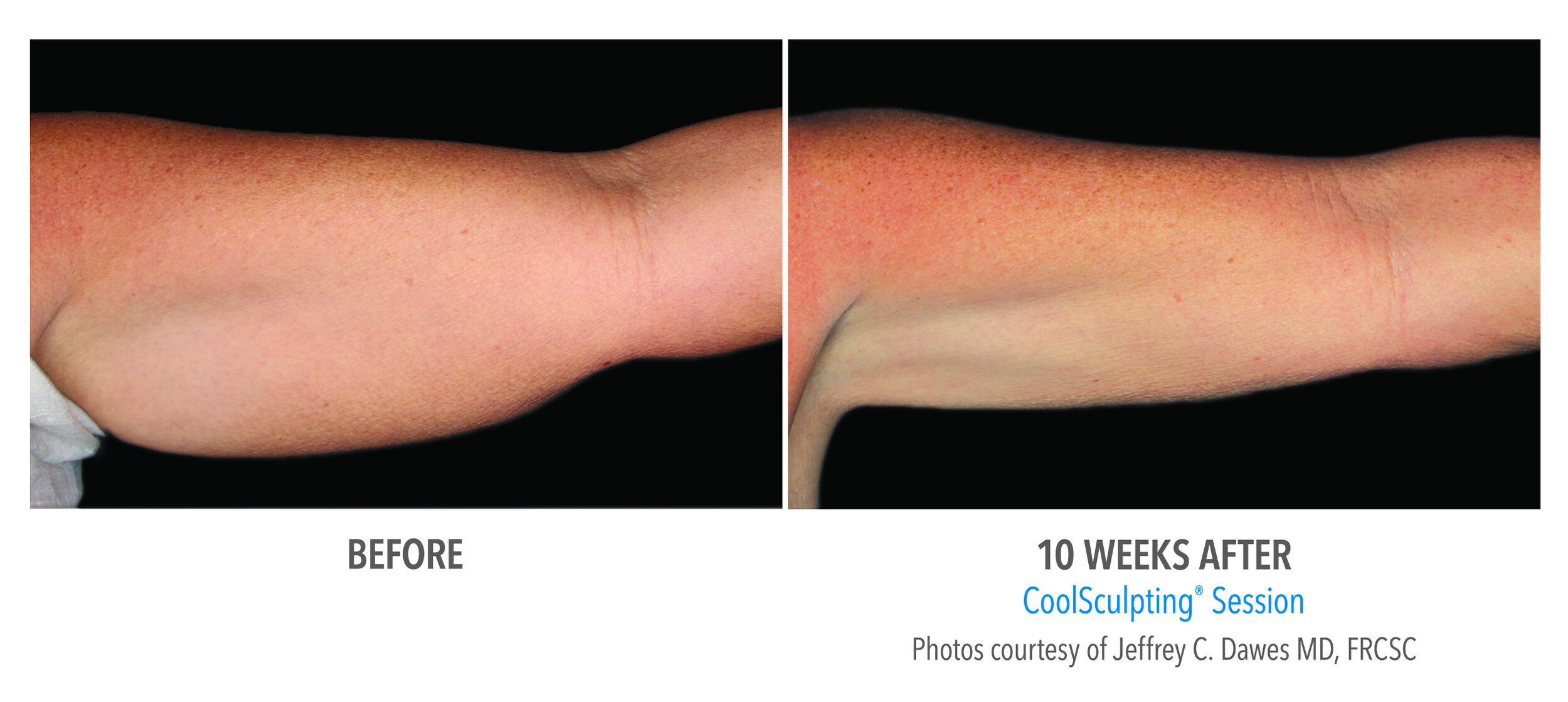 West Dermatology Vancouver CoolSculpting  Arm.jpg