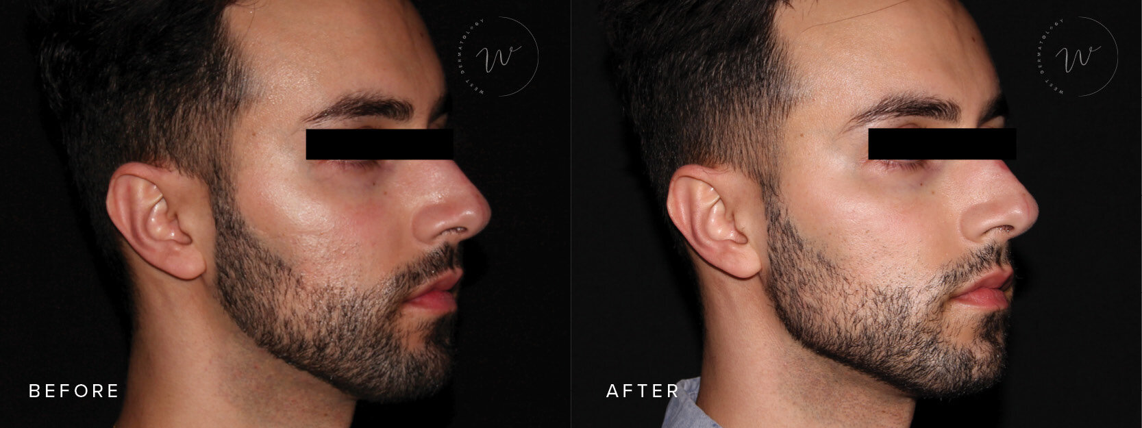 Jawline Sculpting