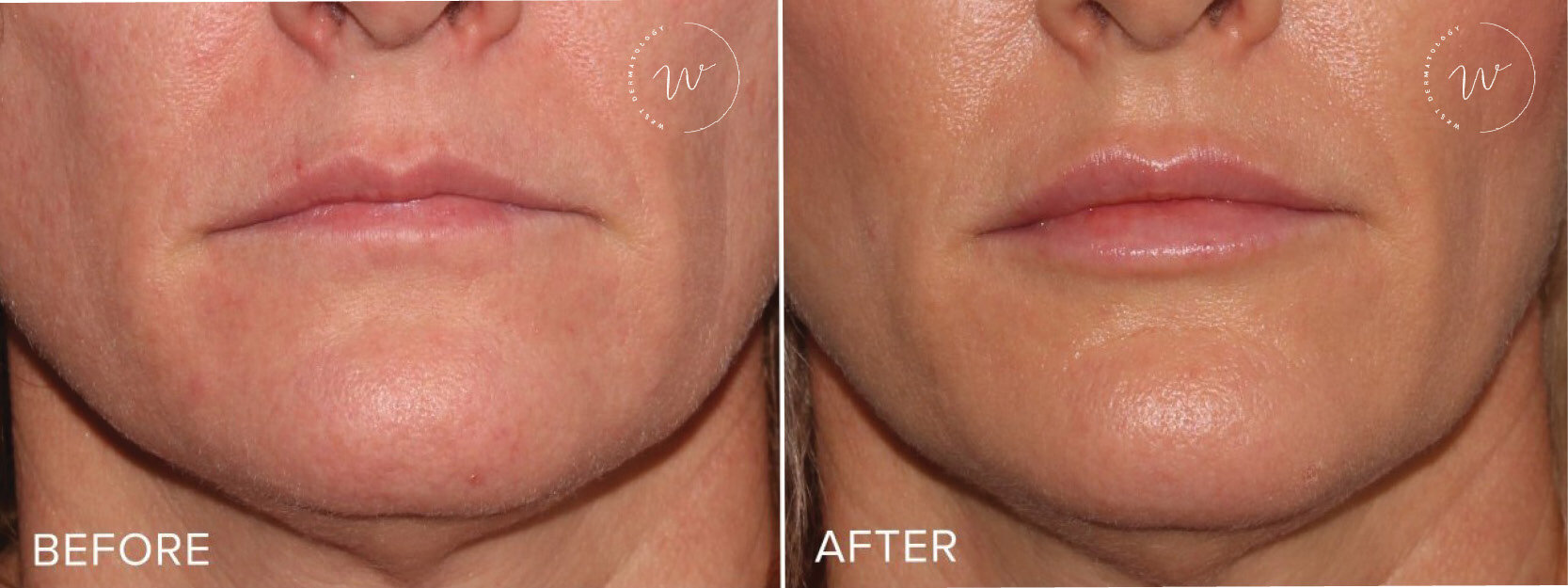 Lip Augmentation