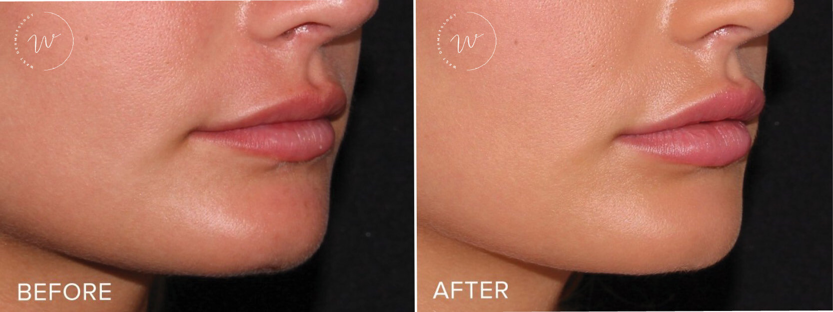 Lip Augmentation