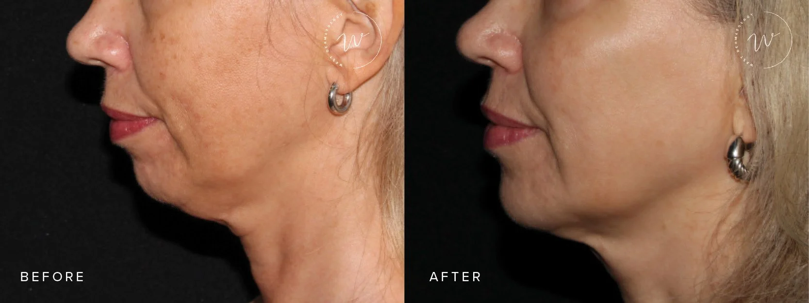 Lower Face Botox? Here Are The Benefits West Dermatology