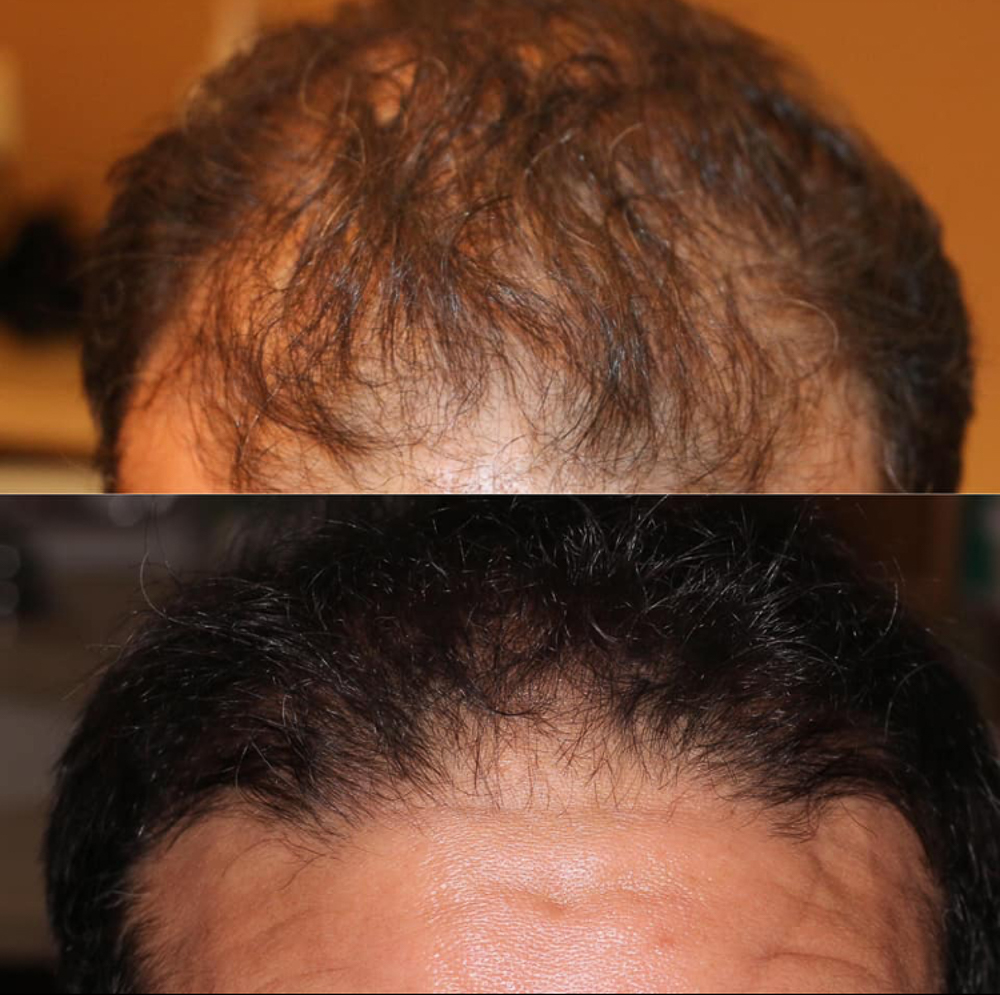 Hair replacement in as little as 4 weeks — Anderson Longevity Clinic ®