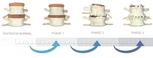 Degeneration is treated by our Little Rock chiropractors to give you relief from back pain.