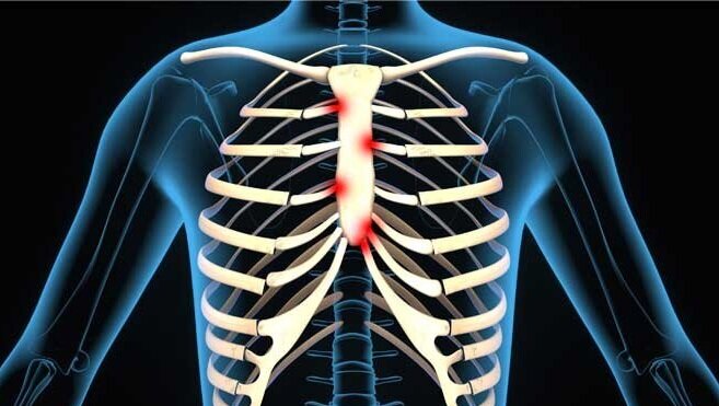 Tietze syndrome can often be misdiagnosed and be a cause of chest pain.