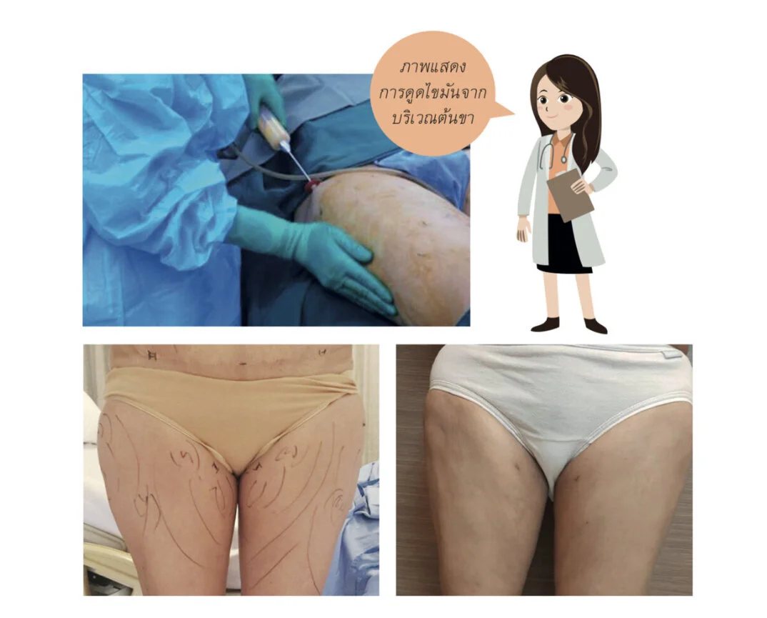 อ่านให้เคลียร์ ก่อนจะเลือกวิธี “ดูดไขมัน”