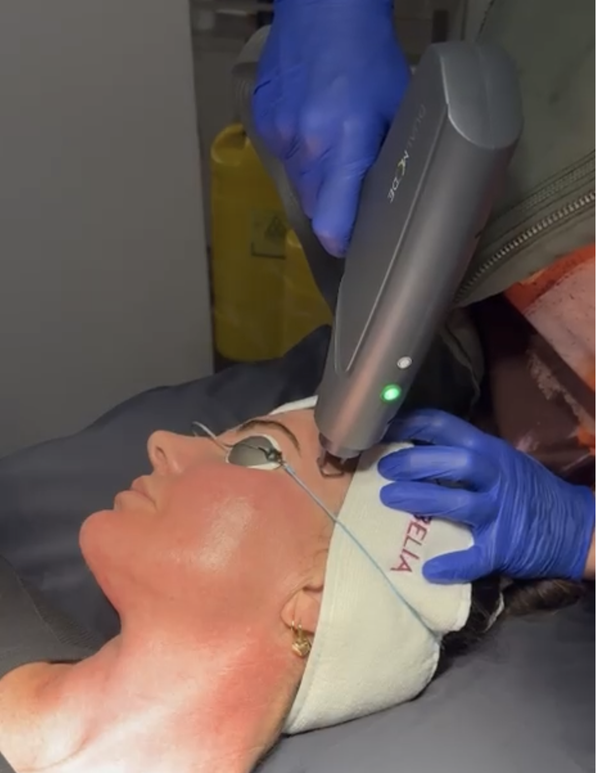 DualMode Laser treatment Port Macquarie