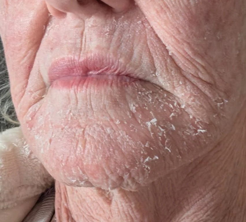 Peeling skin after DualMode Laser treatment