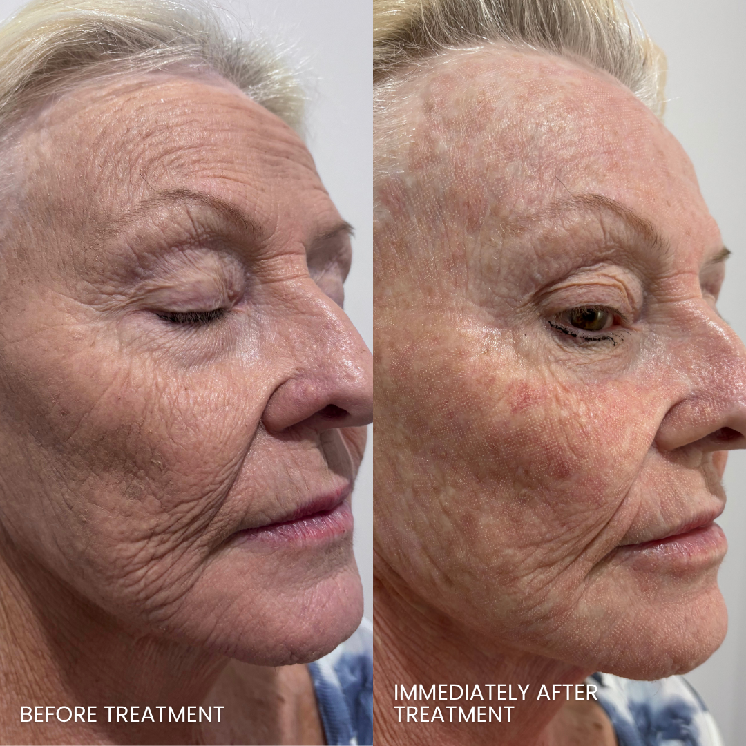 DualMode Laser immediately after treatment