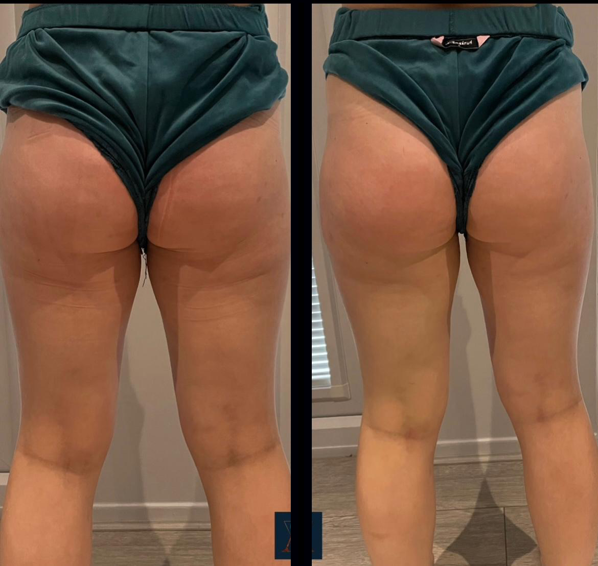 arse with black line.png
