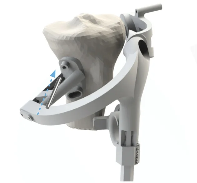 Embody+3D+Printed+Guide+High+Tibial+Osteotomy.jpg