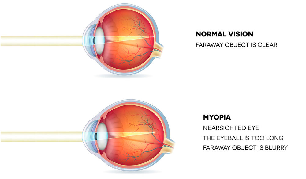 Gyakorlatok a helyreállítása és javítása látást rövidlátás (myopia) az enyhe-közepes