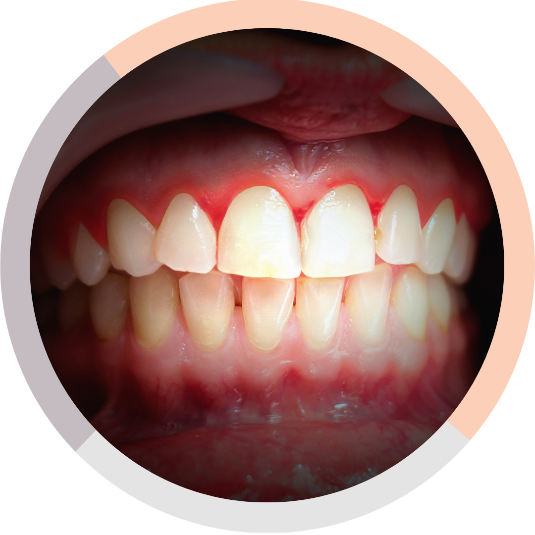 Bleeding/Swollen Gums What to do Next? Melbourne Dentist in Malvern East