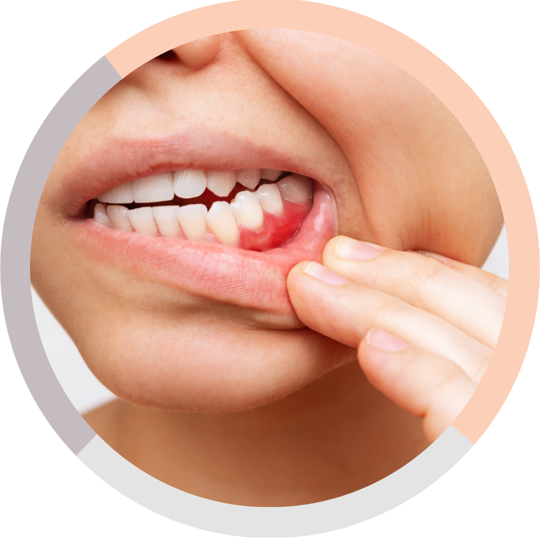 Bleeding/Swollen Gums What to do Next? Melbourne Dentist in Malvern East