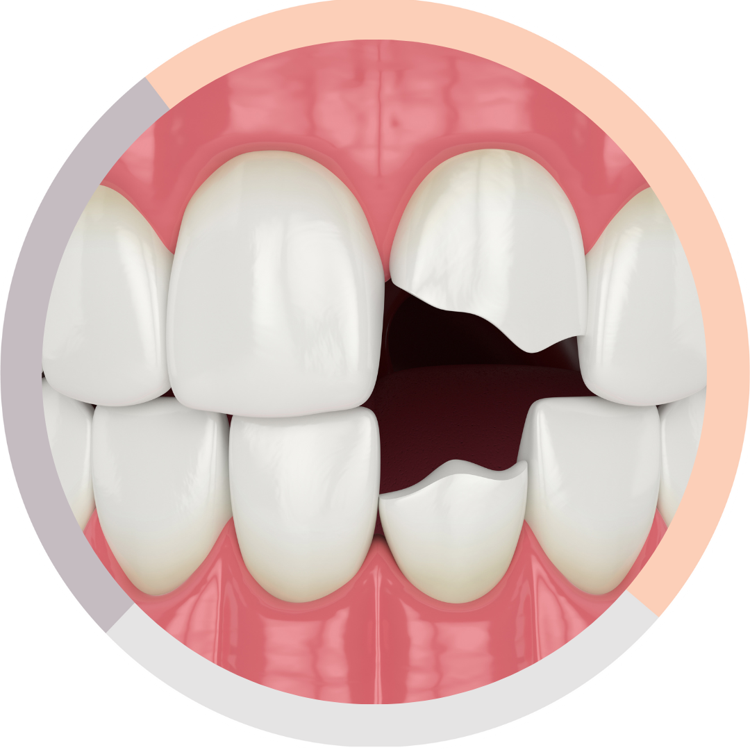 Broken or Chipped Tooth - What to do? - Malvern Dentist | Melbourne