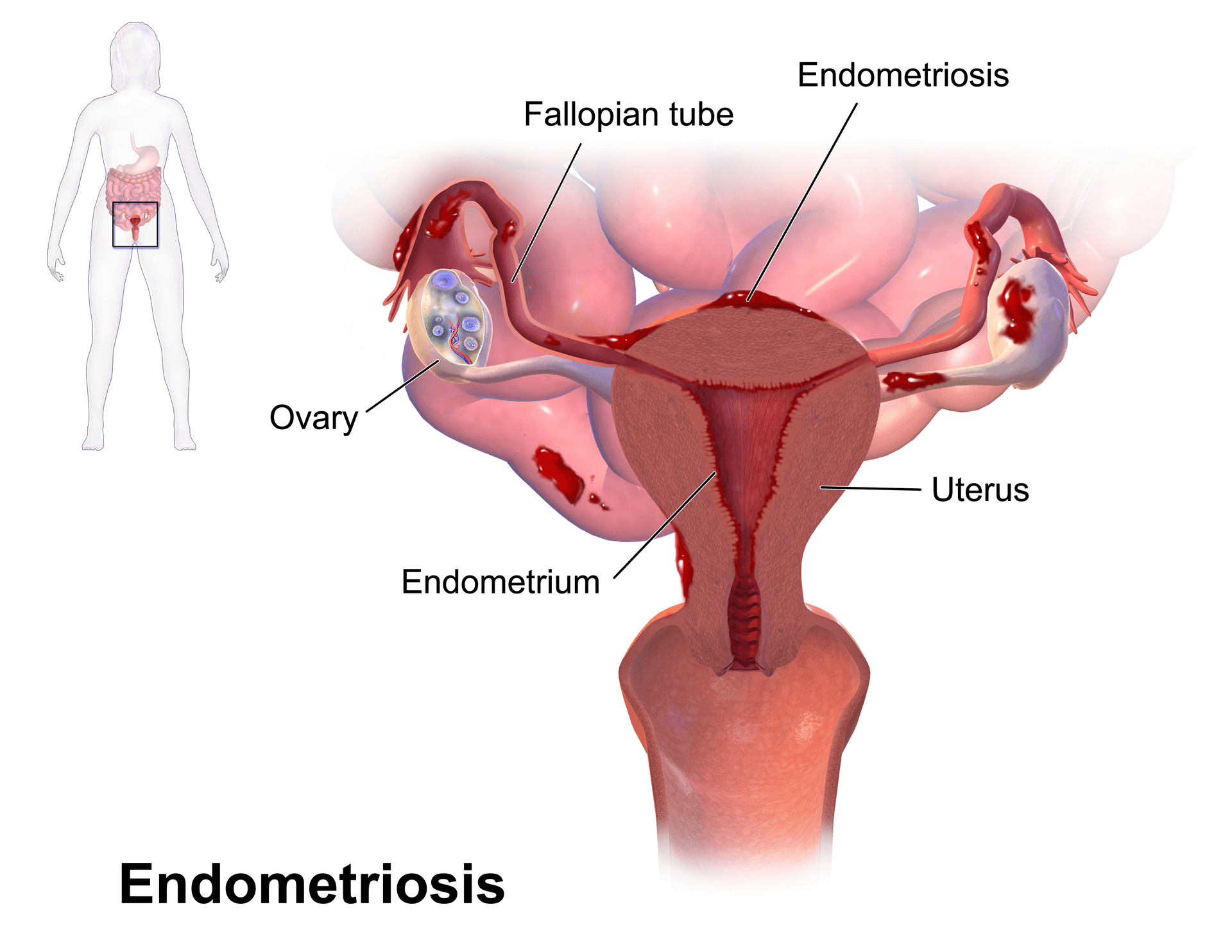 Endometriosis Relief Naturally: Manage Pain with Yoga Therapy | Wild Womb