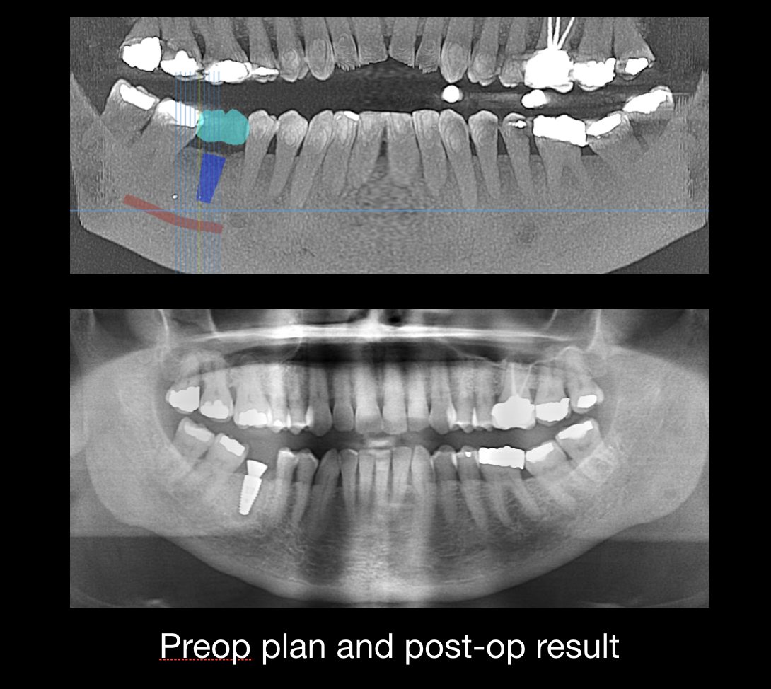 Guided implant surgery: virtual implant plan on a 3D CT scan (top) and post-op x-ray showing the implant placed in the planned position (bottom)