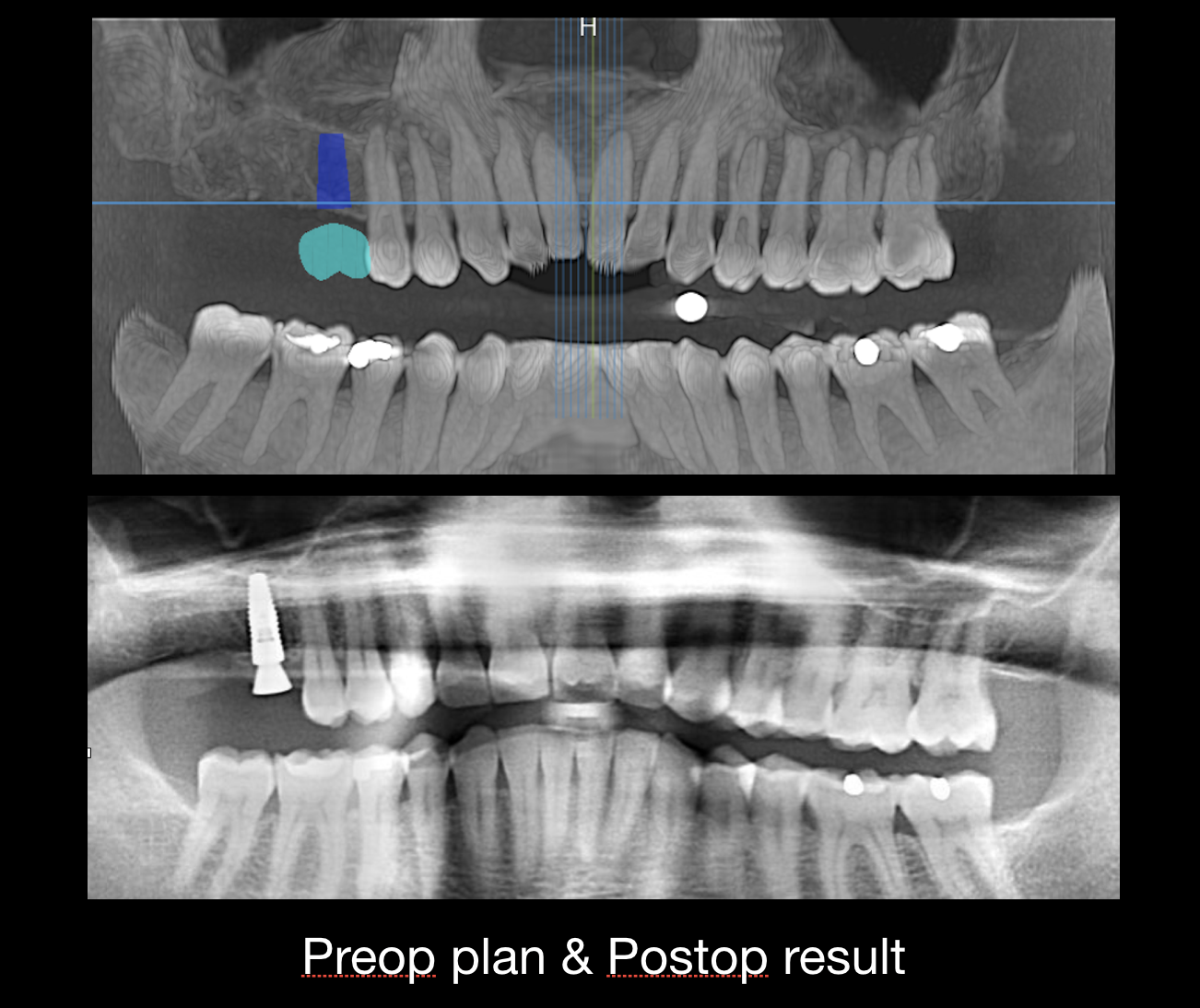 Guided implant surgery case: 3D CT implant plan (top) and post-op panoramic x-ray of the placed implant (bottom)