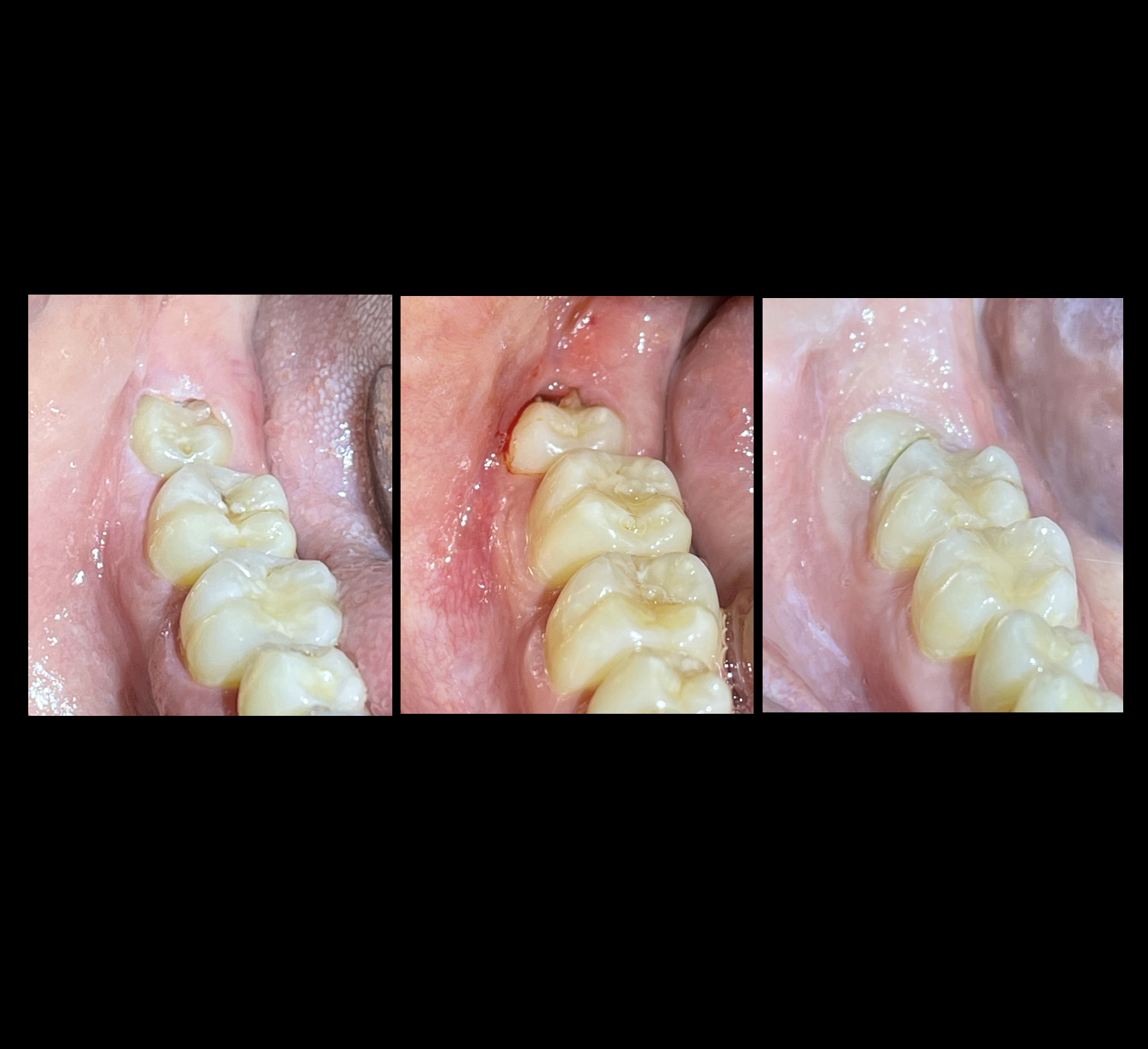 wisdom teeth before and after