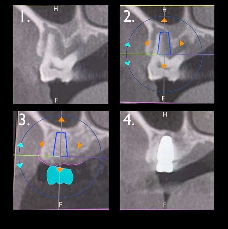 A fractured tooth resulted in local infection and bone loss.

Thorough planning from the start identified infection that needed removed and where bone was needed to place a future implant. Guided surgery was used to place the implant in ideal locatio