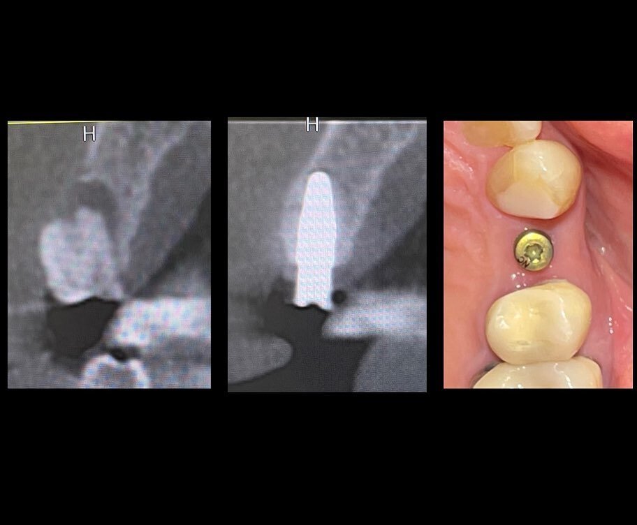 Infected teeth often have significant bone loss that destroys the local jaw bone.

If a patient wants an implant to replace a tooth, it&rsquo;s crucial to plan for enough jaw bone to support a dental implant. 

This case shows a premolar with infecti